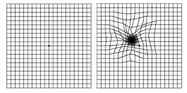 정상인이 본 암슬러격자(왼쪽)와 황반변성 환자가 본 암슬러격자(오른쪽).