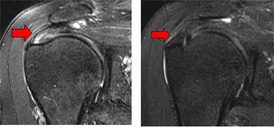 왼쪽 사진은 회전근개 부분 파열(화살표 부위) MRI 검사 장면. 오른쪽 사진은 회전근개 부분 파열 부위에 아텔로콜라겐 주사 6개월 후 시행한 MRI 검사에서 회전근개 파열 부위가 회복됐다(화살표 부위). 서울성모병원 제공