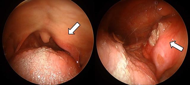 편도암이 관찰된 최 씨의 후두 내시경 영상
