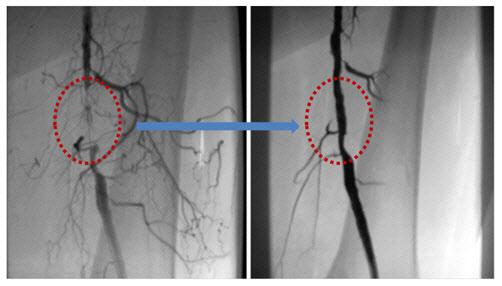 좁아진 대퇴동맥(왼쪽)에 풍선확장술을 시행한 뒤 정상적인 혈류 흐름을 보인다(오른쪽).