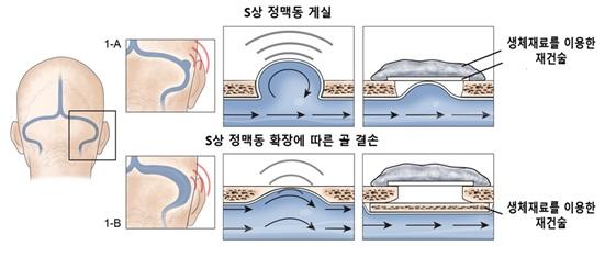 그림 1. S상 정맥동 게실 이상으로 시행한 재건술 방법 (1-A)