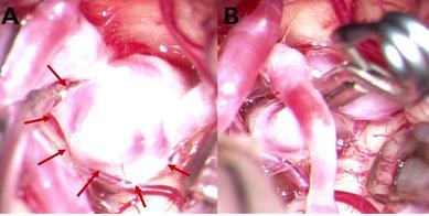 A-클립결찰술 전(화살표: 뇌동맥류) B-클립결찰술 후