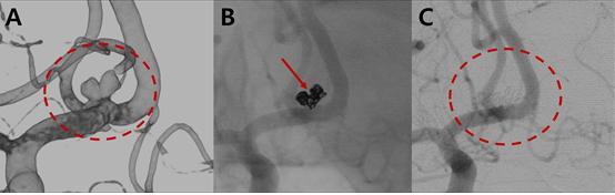 A-코일색전술 전(점선: 뇌동맥류), B-뇌동맥류 안에 삽입된 코일, C: 코일색전술 후