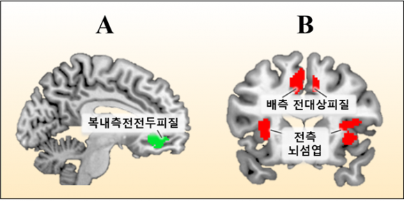 A. 신체 질환자, B. 정신 질환자에게 위로와 격려를 보냈을 때, 이를 바라보는 정상인의 뇌를 기능적 자기공명영상(fMRI)으로 촬영했다. 활성화되는 부위가 서로 다르다. 서울대병원 제공