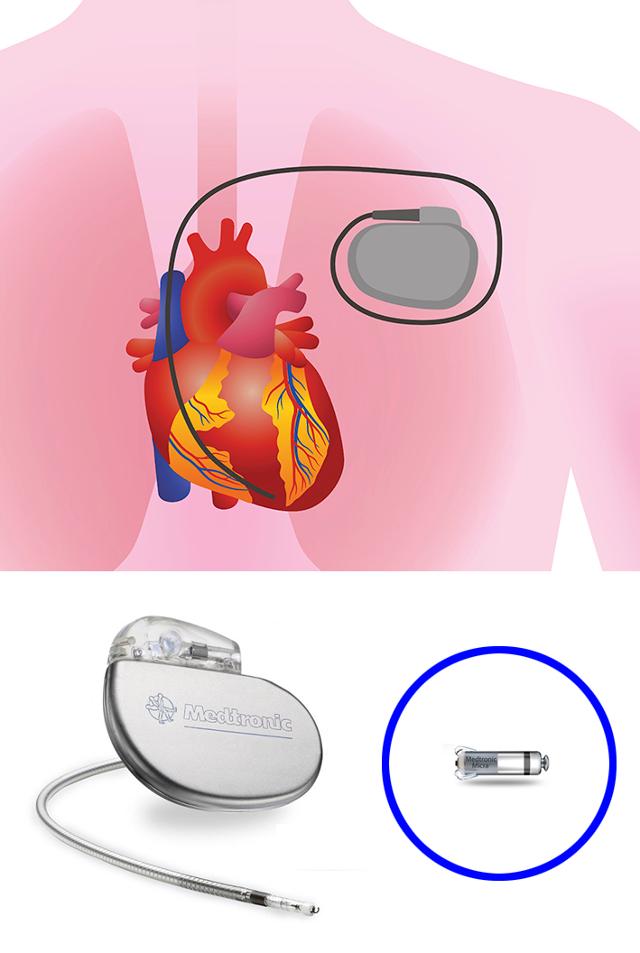 몸에 삽입하는 전선이 달린 인공 심박동기와 대퇴 정맥을 통해 시술로 삽입하는 메드트로닉社 무선 심박동기 '마이크라'(파란색 원 안). 서울대병원 제공