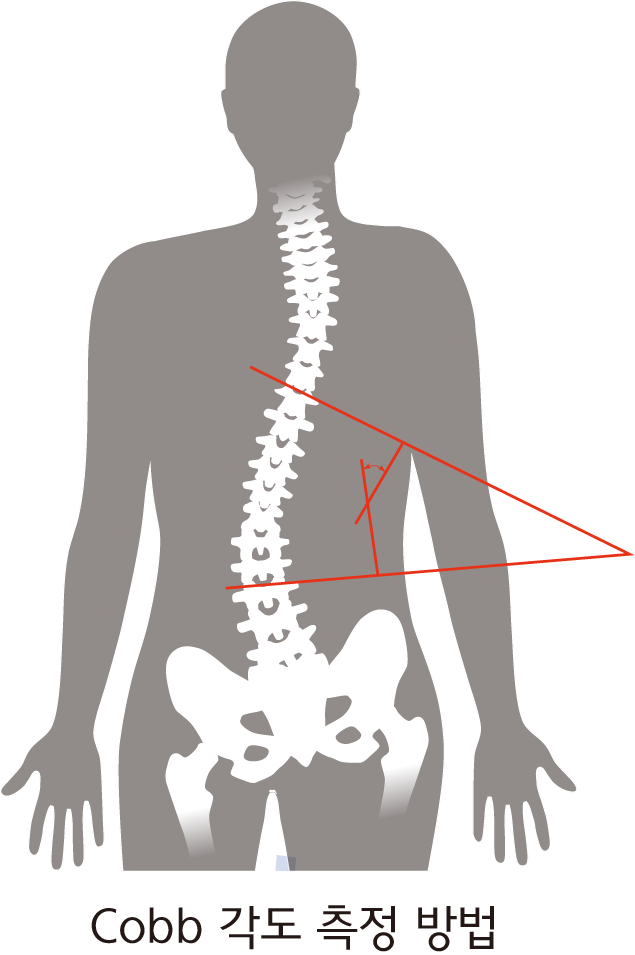 커브 각도(Cobb’s angle) 측정법. 인천성모병원 제공