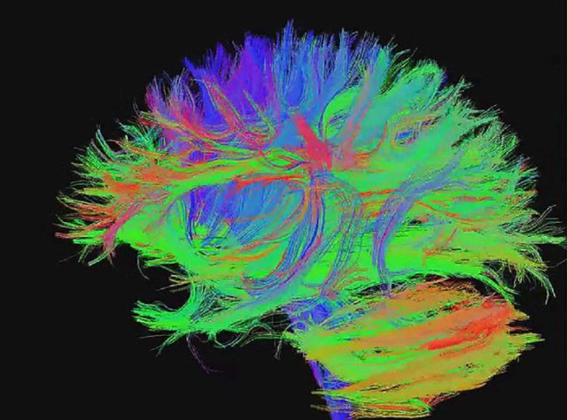 휴먼 커넥톰 확산 텐서 이미징 데이터 Human Connectome Diffusion Tensor Imaging. 사진: J.G. Marcelino, 출처: Human Connectome Project, Wikimedia Commons