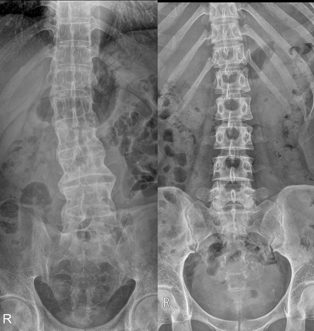 강직성 척추염(왼쪽)은 정상 척추(오른쪽)보다 관절 없이 하나의 긴 뼈처럼 이어진 모습을 보여 ‘대나무 척추(bamboo spine)’라고도 불린다. 인천성모병원 제공