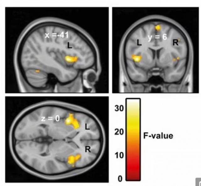 미소포니아 환자의 뇌를 기능성 자기공명영상(fMRI)으로 촬영한 사진. 뉴캐슬대 제공