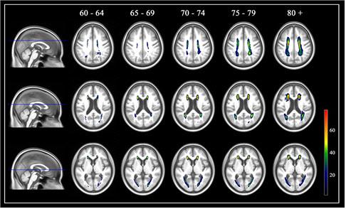 한국인 노인들을 대상으로 한 맞춤형 연령별 대뇌 백질 고강도 신호 확률 지도. 분당서울대병원 제공