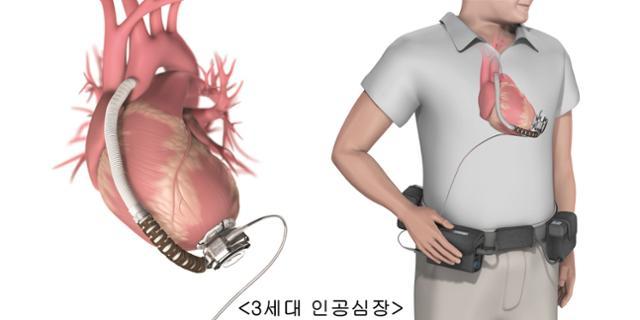 좌심실 보조 장치. 서울아산병원 제공