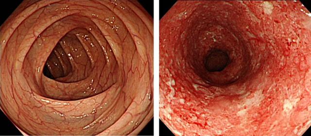 정상인(왼쪽)과 궤양성 대장염 환자의 장 내시경 사진