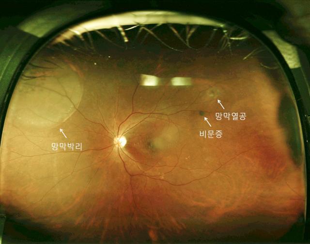 망막박리와 망막 열공이 생긴 비문증 환자의 망막 모습.