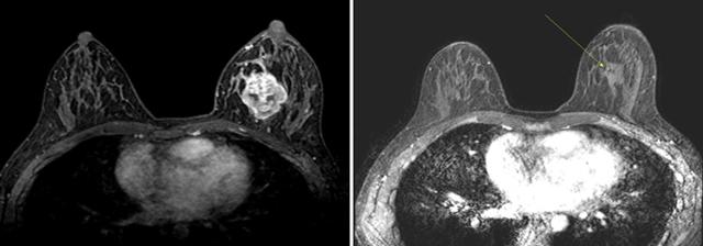 김씨의 진단 당시(왼쪽)와 항암치료 후 유방 MRI 영상. 노란색 화살표 부분에 위치한 종양이 거의 보이지 않을 정도로 줄어들었다.