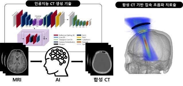 인공지능 합성 CT 기반 집속 초음파 치료술 모식도. KIST 제공