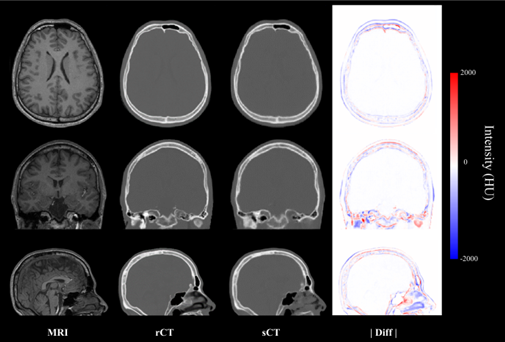 실제 CT(rCT)와 MRI 영상 합성 CT(sCT)의 오차(|Diff||를 보여주는 예시. 실제 CT와 합성 CT에는 큰 차이가 보이지 않는다. KIST 제공